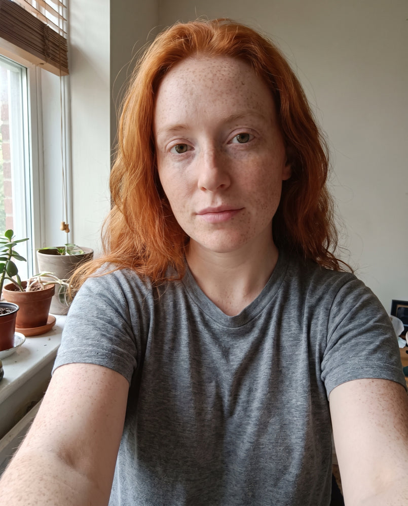 Before — fair freckled skin, week 1